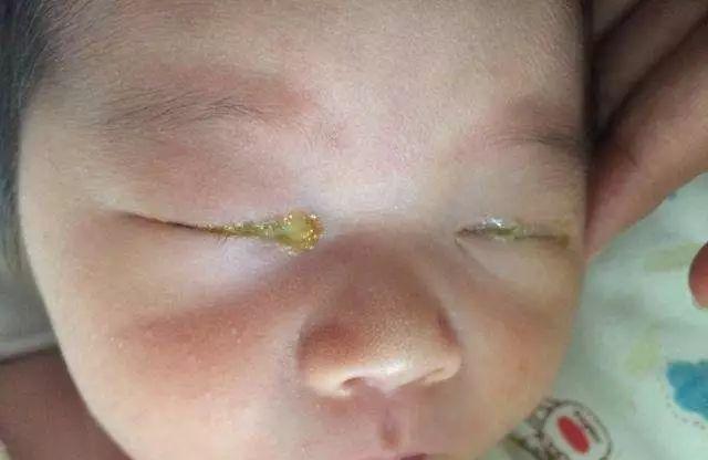 宝宝眼睛容易流泪，眼角发红有眼屎是怎么回事？