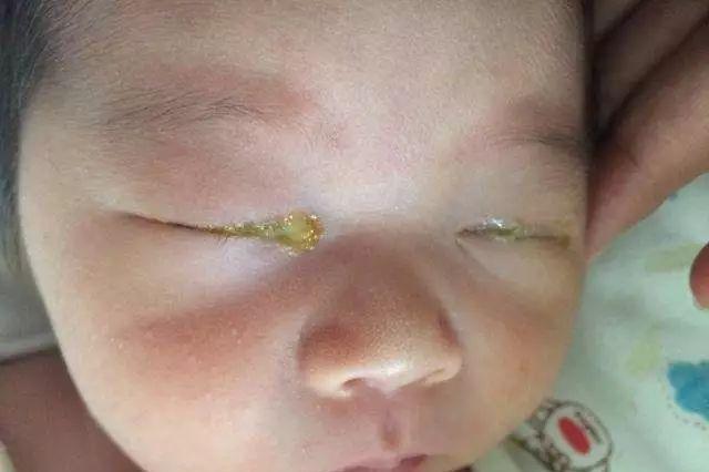 宝宝眼睛容易流泪，眼角发红有眼屎是怎么回事？