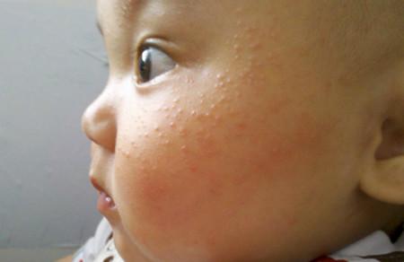宝宝出疹子注意事项，需要和哪些疾病鉴别？