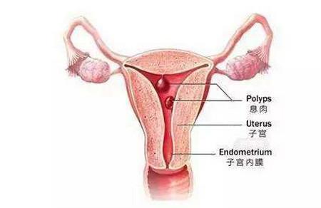 子宫内膜息肉到底是什么东西？内膜息肉怎么影响怀孕？