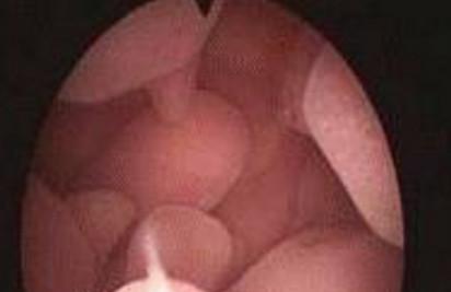 什么是子宫内膜息肉？它会影响怀孕吗？