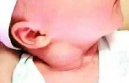 粗心妈妈把孩子抱成“歪脖子”，宝宝斜颈如何治疗？