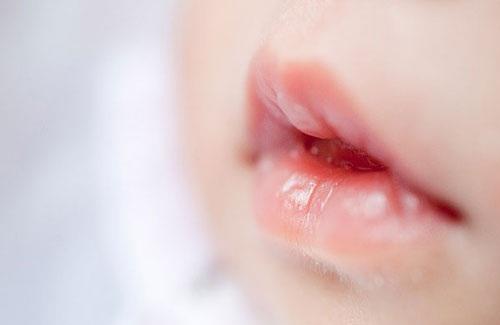 宝宝嘴唇干裂是什么原因 为什么宝宝嘴唇会干裂，妈妈必知