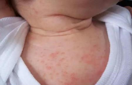 婴儿粉刺和湿疹有什么区别？