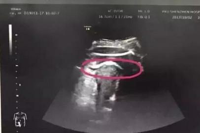 子宮破裂是怎么回事？如何避免子宮破裂