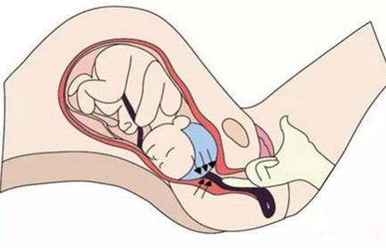 医师跪地托举25分钟挽救胎儿生命，脐带脱垂你了解多少？
