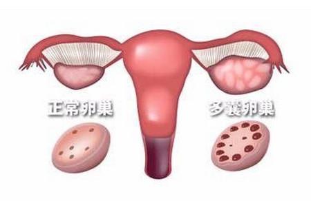 多囊与不孕之间有什么关系？有那么多卵泡为什么怀不上孕？