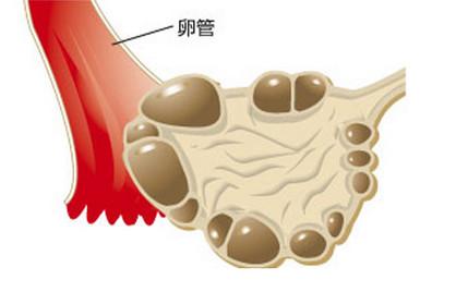 什么时候最适合治疗多囊卵巢综合征？