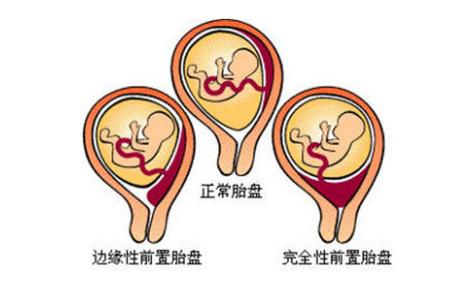 什么是前置胎盘？前置胎盘是怎样造成的？如何预防？