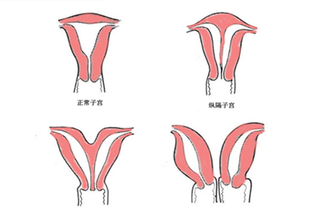 双子宫怀孕会来月经吗 是否与常人有异呢