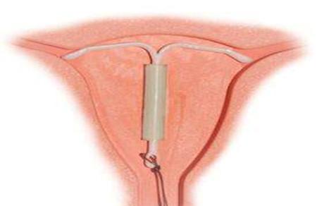 双子宫可以上环吗 别浪费最佳避孕方法