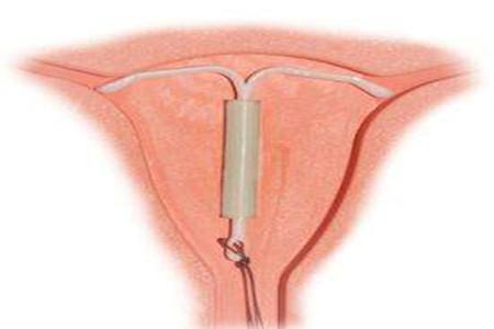 双子宫可以上环吗 别浪费最佳避孕方法