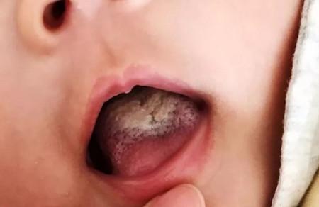 宝宝积食会引发5种疾病，宝宝积食该怎么护理？