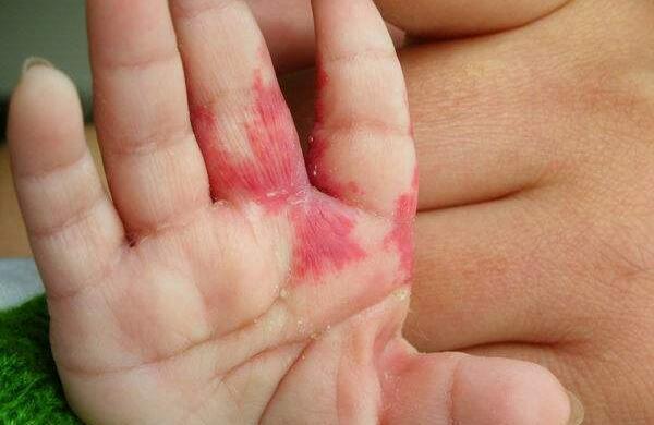 小儿血管瘤的危害 血管瘤对宝宝有什么危害