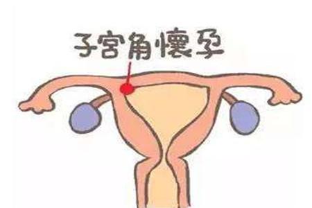 宫腔积血和宫腔积液的区别 这些方面来分辨