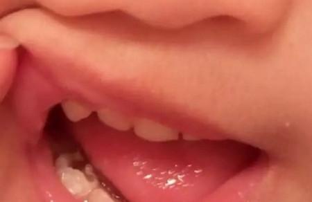 关于宝宝关于窝沟封闭，为何等不得？