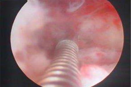 宫角妊娠手术危险大吗 危险因素要减少