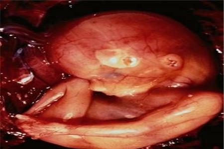 宫角妊娠回正位的办法 让你远离手术迫害