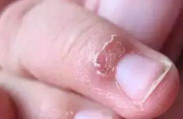 宝宝手上长倒刺是不是因为缺维生素呢？？？