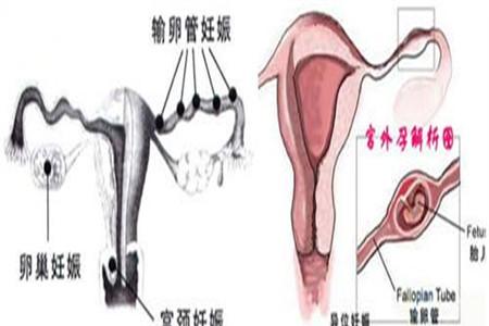 宫角妊娠能游到宫内吗 你不知道的神奇变化