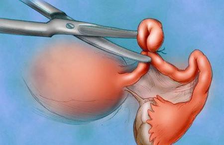 输卵管结扎术后真的就没有宫外孕了么？！