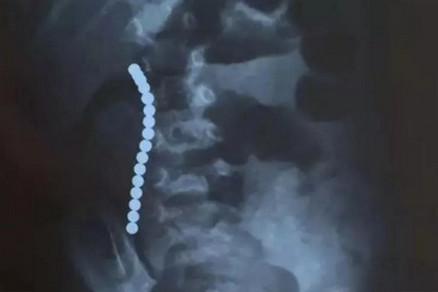 宝宝吞下异物后会有什么样的表现？该怎么处理？