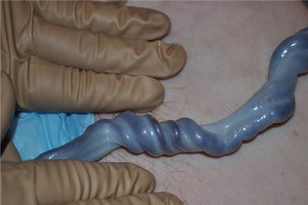 脐带扭转跟基因有关吗 带你了解脐带扭转的真正病因