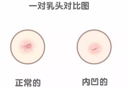 乳头内陷该如何喂奶？乳头内陷怎么矫正？