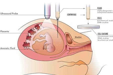 羊水浑浊与吃喝有关吗 孕期饮食要谨慎