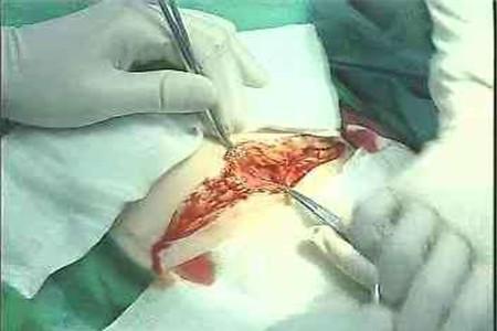 羊水浑浊要剖腹产吗 剖腹产别着急