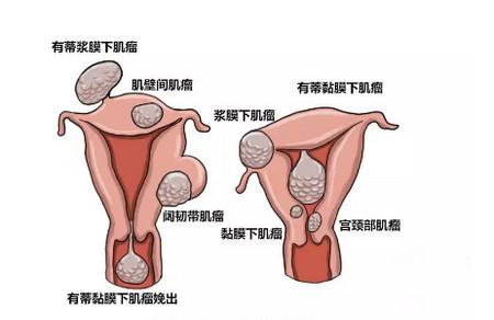 了解子宫肌瘤，不再“谈肌瘤色变”！