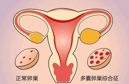 备孕遇上多囊卵巢综合征，该怎么办？