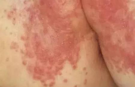 宝宝红臀也有可能是真菌、细菌感染，正确处理办法都在这里！