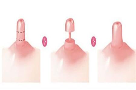 乳头内陷图片对比 教你一秒分辨