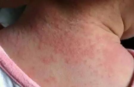 婴幼儿常见的皮疹，该如何辨别区分呢？