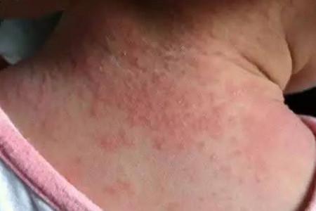 婴幼儿常见的皮疹，该如何辨别区分呢？