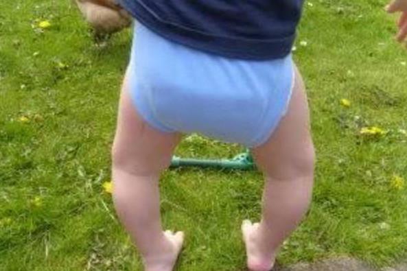 宝宝有O型腿，X型腿？宝宝要不要矫正呢？