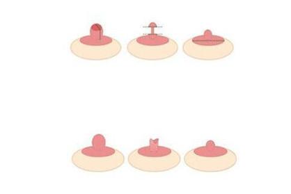 乳头内陷的程度区分图 乳头内陷分为几个程度呢？