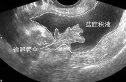 盆腔积液，这个几乎每个女人都有的问题，究竟是什么？