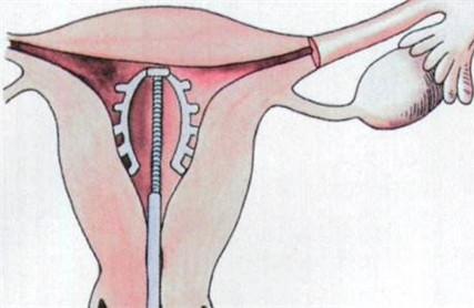 取环后出血多是怎么回事 取环后出血不容忽视
