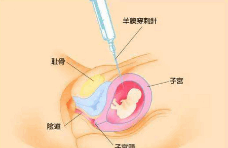 产科医生告诉你“羊水穿刺”背后的真相！