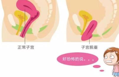 盆底康复，产后妈妈不要忽视了！