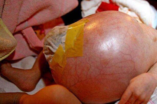 寄生胎可以存活吗