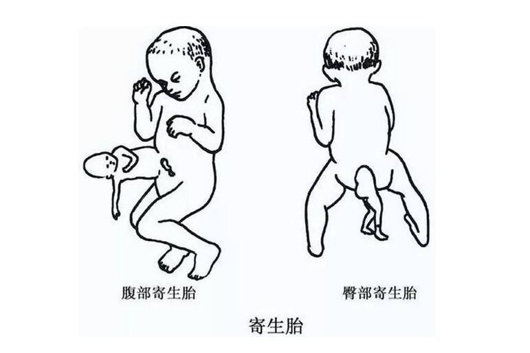 怎样预防寄生胎