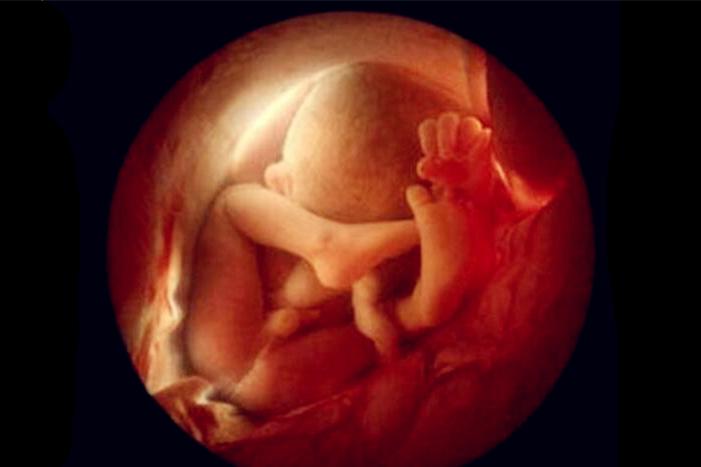 寄生胎是什么意思