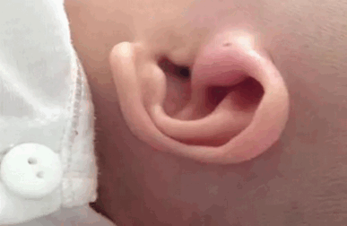 宝宝耳朵上的这个小孔，一捅就坏事！