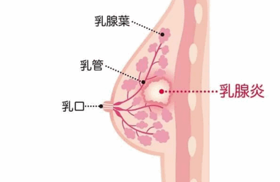 哺乳期乳腺炎怎么办？