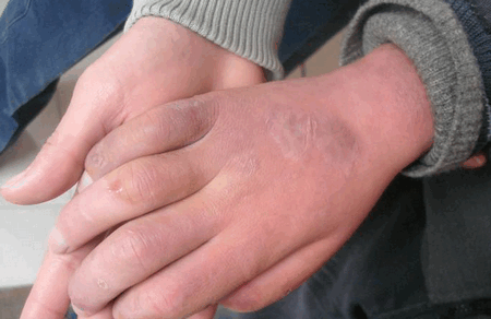 冬天宝宝有冻疮？推荐你几个外治小妙招，很管用！