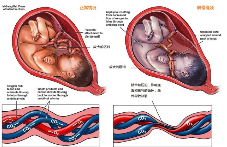 4个孕妇就有1个遇到过脐带问题，需要赶紧剖出来哦！