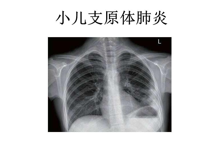 小儿支原体肺炎治疗方法